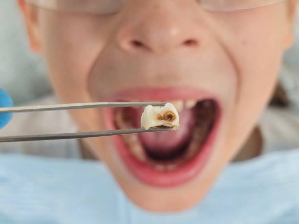 Best Broken or Cracked Tooth Emergency Dentist in Ballville, OH